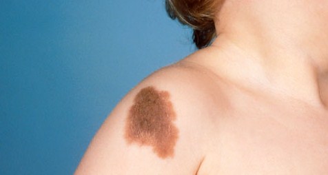 Why do people have birthmarks